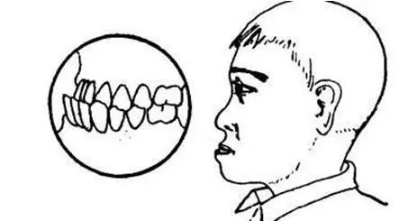 牙齿不齐面相_牙齿缝隙大的人面相_牙齿大的人面相