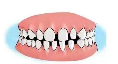 牙齿缝隙大的人面相_牙齿大的人面相_牙齿不齐面相