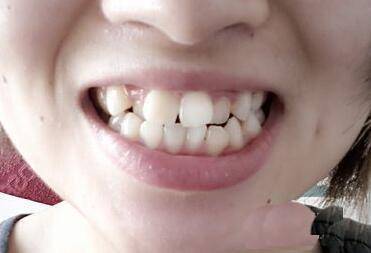 面相牙齿与命运_牙齿不齐面相_牙齿比较长的面相