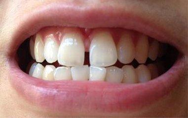 面相牙齿与命运_牙齿比较长的面相_牙齿不齐面相