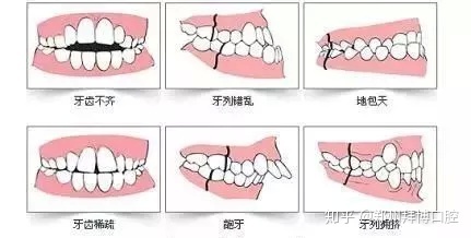 牙齿矫正治疗牙齿拥挤最为常见，有60%的错畸形患者存在牙齿拥挤