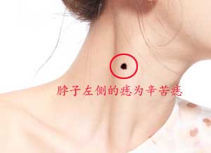 女人脖子长痣预示着什么？脖子有痣的作用！