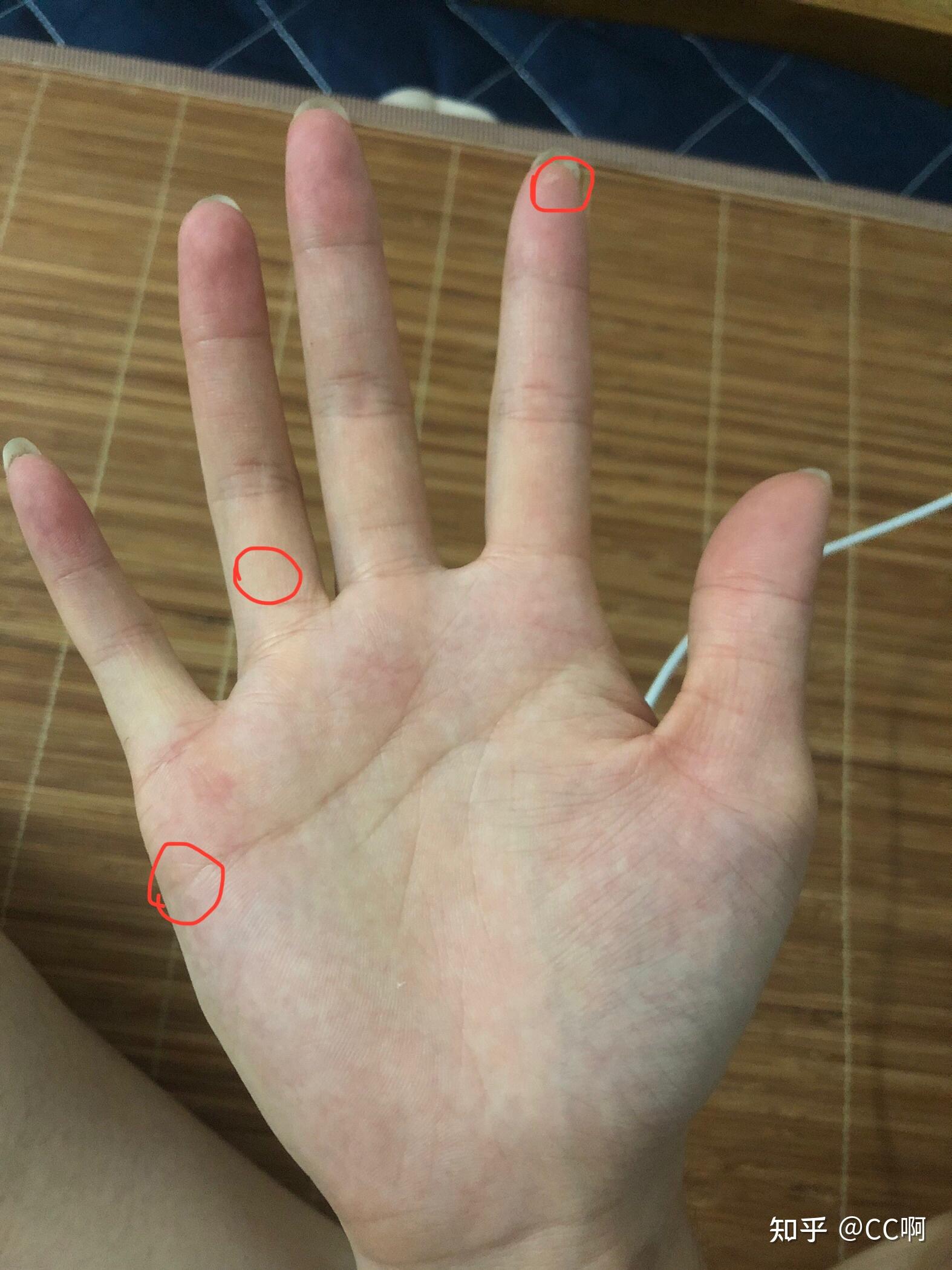 （李向东）女人左手中指有痣代表什么？你知道吗？