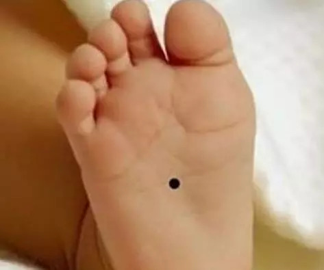 宝宝脚底板上长了一颗小黑痣，天生帝王命
